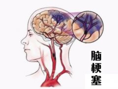 養(yǎng)成好的生活習(xí)慣，能夠有效預(yù)防腦梗塞